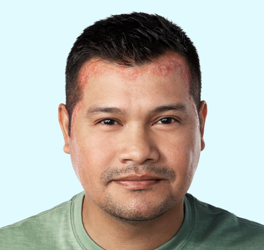 Man for scalp psoriasis advice